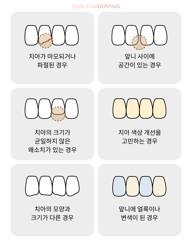 스마일랩핑이란? 무삭제 가능 여부부터 원데이 치료까지 <총정리> 관련 이미지 11