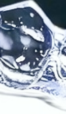 강남 임플란트 치과 초기 단계의 정밀한 분석이 중요한 이유 관련 이미지 30