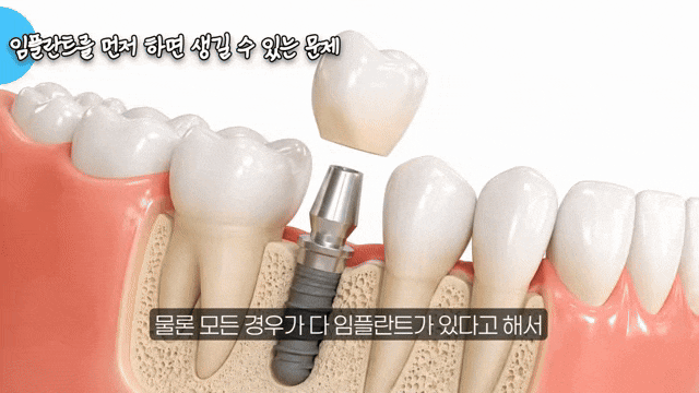 임플란트 수명은 얼마나 되나요? 관리에 따라 달라지는 진짜 이유 관련 이미지 1