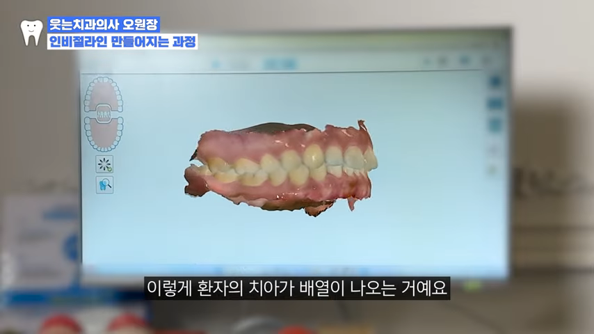 인비절라인후기로 알아본 인비절라인치과 선택 Tip 관련 이미지 5