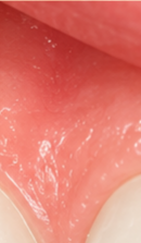 What to Check When Considering No-Prep Laminate Veneers in Gangnam image 31