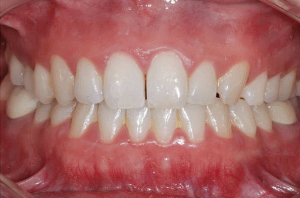 How Can You Fix Front Teeth Gaps After Orthodontic Treatment? What to Do When You Really Don’t Want Retreatment <Must Read> image 2