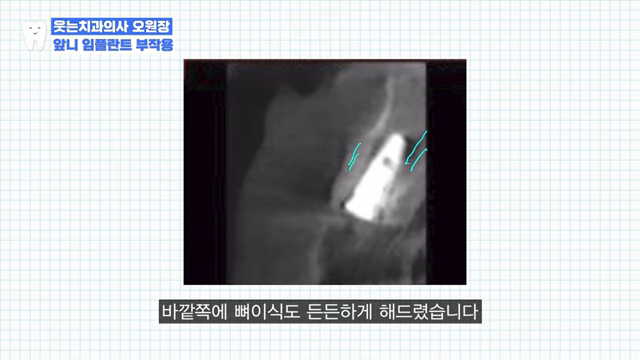 임플란트 OO하게 심으면 가짜 이빨 다 티납니다 관련 이미지 8