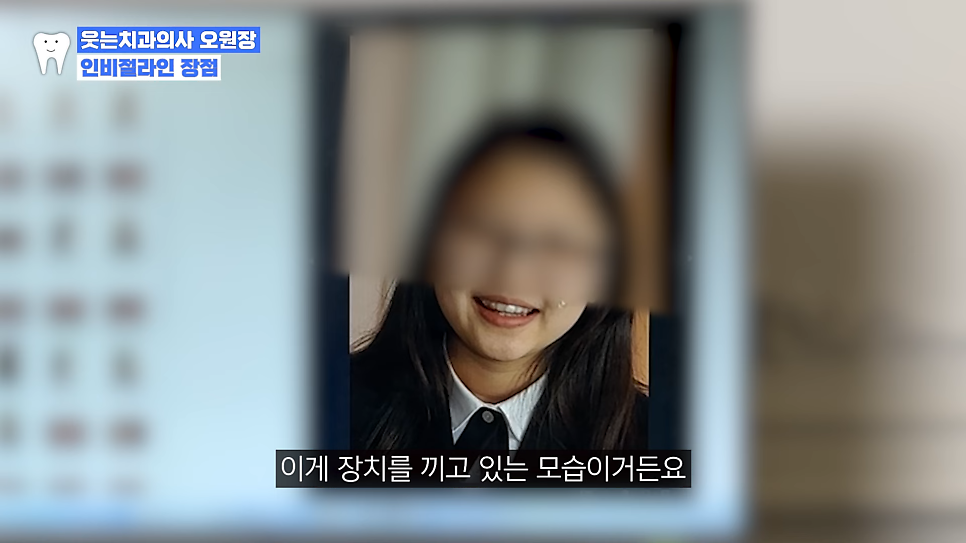 투명 교정 가격과 개방교합 인비절라인 장점에 대해 관련 이미지 7