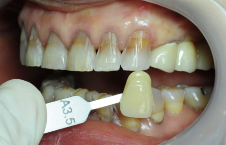 Front Tooth Laminate? Front Tooth Partial Orthodontics? How to Choose Without Regret image 11
