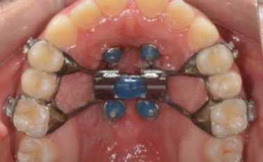 악궁확장 장치로 발치 피한 교정 사례, 나도 가능할까? 관련 이미지 3