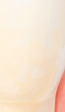 압구정 교정 치과 정밀 진단이 중요한 이유? 관련 이미지 37