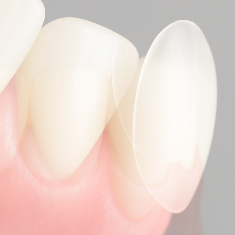 라미네이트 가격 병원 선택 전 꼭 알아야 할 점 관련 이미지 10