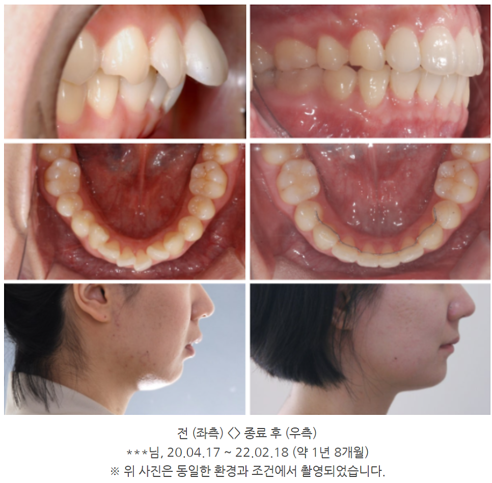 무턱교정전후, 얼굴 라인 어떻게 달라지는지 <공개> 관련 이미지 6