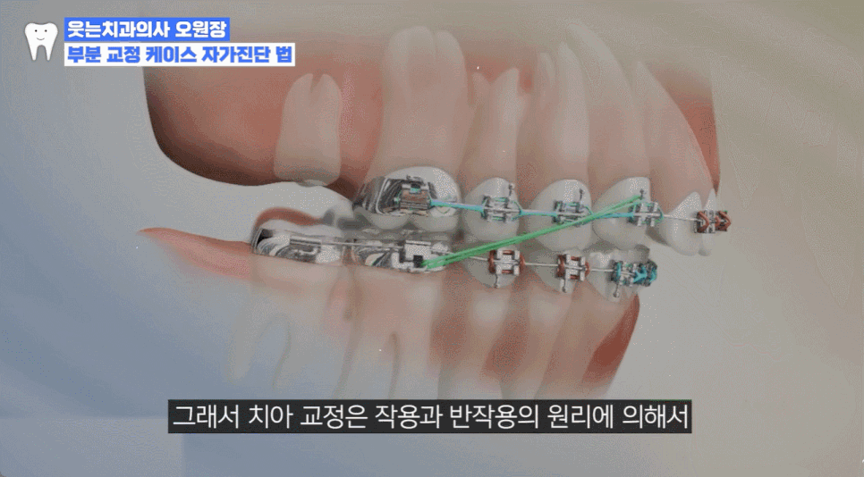 부분교정하고 이렇게 변했습니다 교정 전후 비교 관련 이미지 12