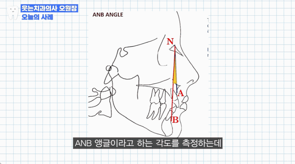 주걱턱 치아교정? 효과적인 주걱턱 교정 시기는 언제 관련 이미지 6