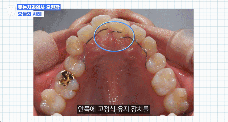 Orthodontic Retainer Period: A Clear Guide image 3