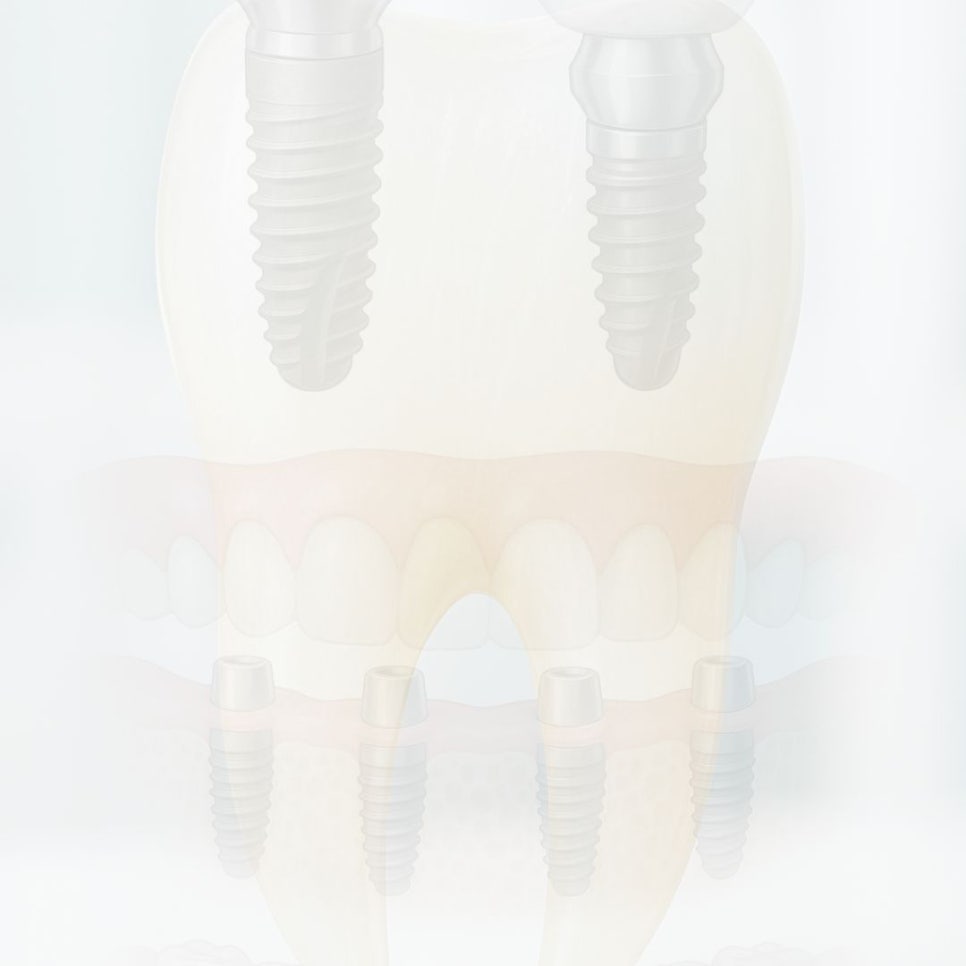 무삭제 라미네이트 후기 꼼꼼히 찾아봤어요 관련 이미지 13