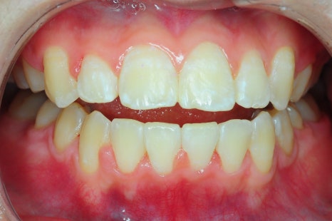 교정후앞니벌어짐, 2년간의 노력이 물거품? 관련 이미지 2