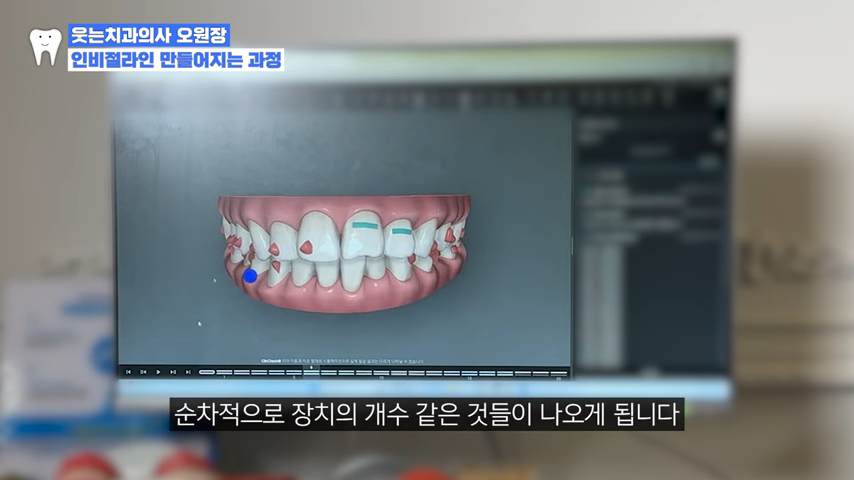 인비절라인후기로 알아본 인비절라인치과 선택 Tip 관련 이미지 4