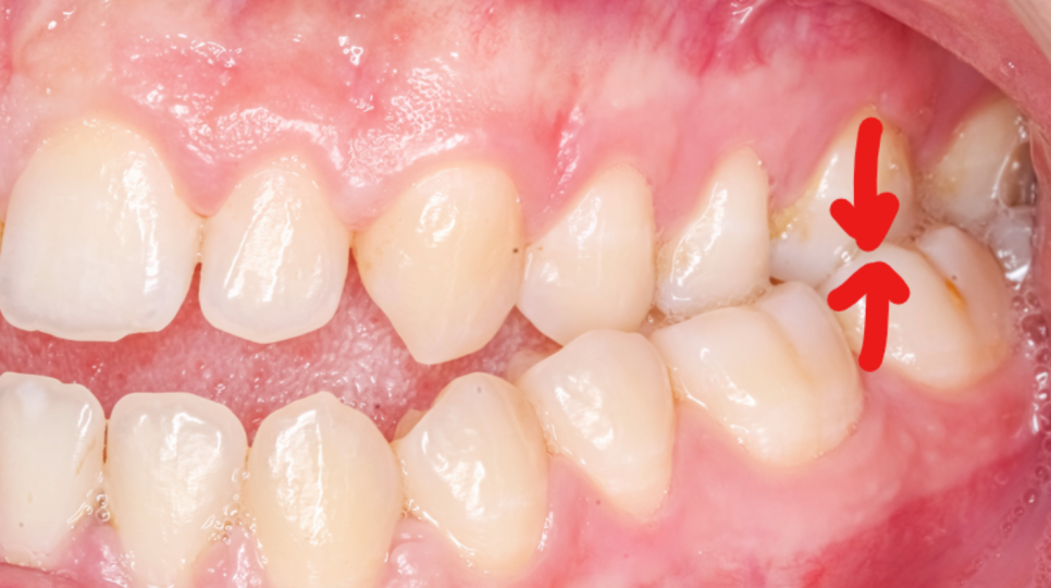 투명 교정 가격과 개방교합 인비절라인 장점에 대해 관련 이미지 3