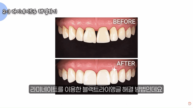 블랙트라이앵글 치료, 강남치과는 어떻게 해결할까? 관련 이미지 11