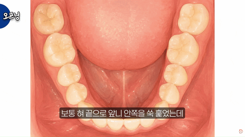 Why Teeth Shift Even When You Wear Your Retainer: 3 Criteria for Deciding Whether Retreat­​​ment Is Needed image 4