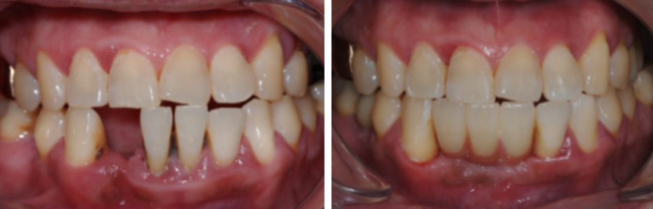 Is Same-Day Implant Possible? What You Must Know Before Implant Surgery image 7