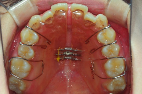 10대 vs 30대 비발치 교정, 얼굴형 변화가 다를 수밖에 없는 이유 관련 이미지 3