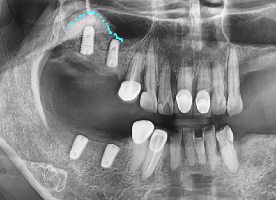 임플란트수술? 발치 즉시 vs 발치 후 임플란트 종류 따져보기 관련 이미지 9