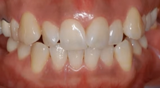 덧니교정 비발치로도 가능할까? 관련 이미지 2