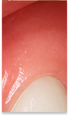 What to Check When Considering No-Prep Laminate Veneers in Gangnam image 34