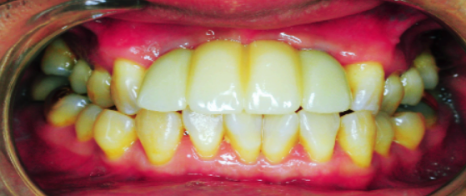 임플란트 뼈이식 비용 들이기 전 이 글부터 읽어보세요 관련 이미지 2