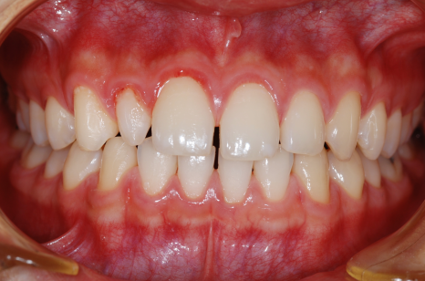 Do not be fooled by no-prep laminate veneers or one-day teeth whitening - how to look better without damaging your teeth image 4