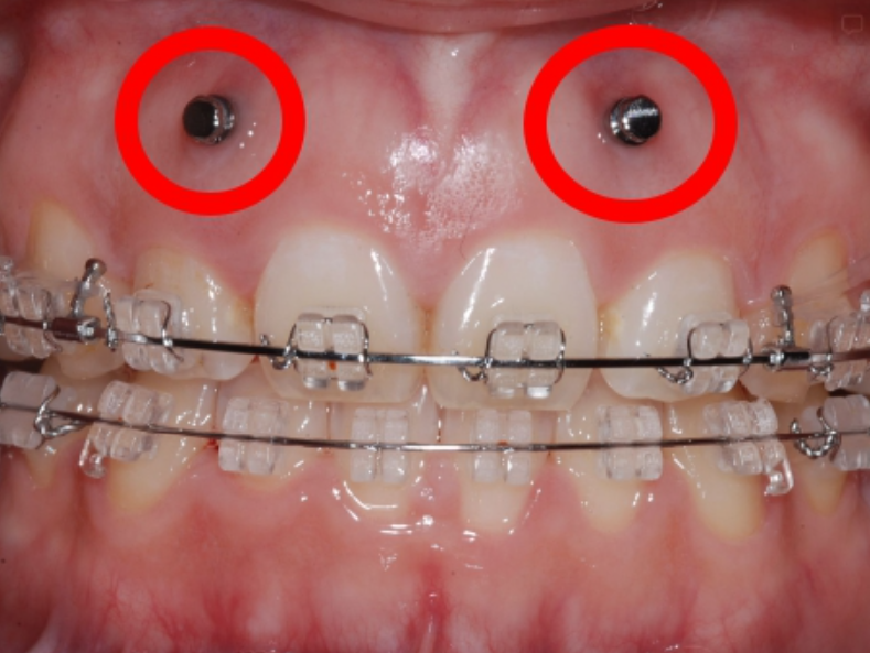 Seoul Orthodontic Clinic: Invisalign drawbacks? Why do they even place Invisalign screws? image 11