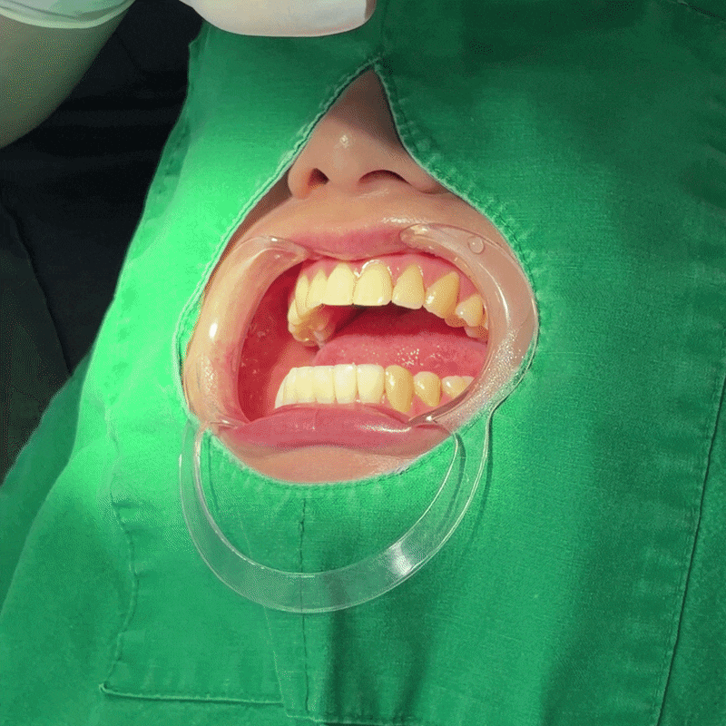스마일랩핑이란? 무삭제 가능 여부부터 원데이 치료까지 <총정리> 관련 이미지 9