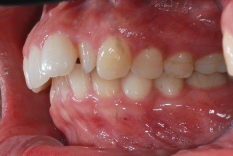 What Is the Key to Correcting Deep Bite and Inward-Tipped Teeth? Must Read to Avoid Retreatment image 2