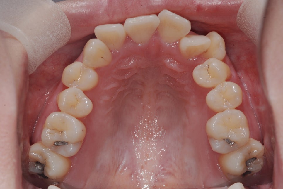 Crooked Teeth Correction? Cases Possible With Partial Orthodontics or Without Extraction image 13