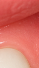 What to Check When Considering No-Prep Laminate Veneers in Gangnam image 33