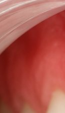 What to Check When Considering No-Prep Laminate Veneers in Gangnam image 28