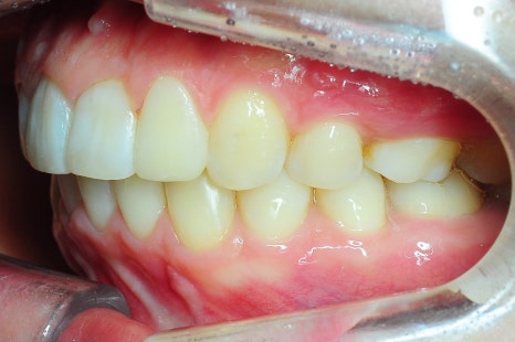 What Is the Key to Correcting Deep Bite and Inward-Tipped Teeth? Must Read to Avoid Retreatment image 3