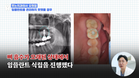 If You Want Your 40s Dental Implant to Last 10 or 20 Years, Check This First image 8
