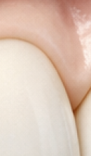 40대 치아 교정 고민 중이라면? 부담 줄이고 효율 높이는 선택법 관련 이미지 26