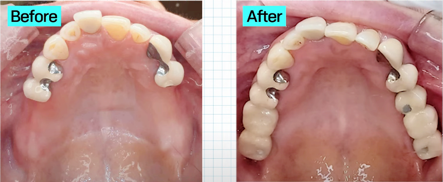 임플란트과정부터 임플란트 치과 고르는 팁까지 A to Z 관련 이미지 1