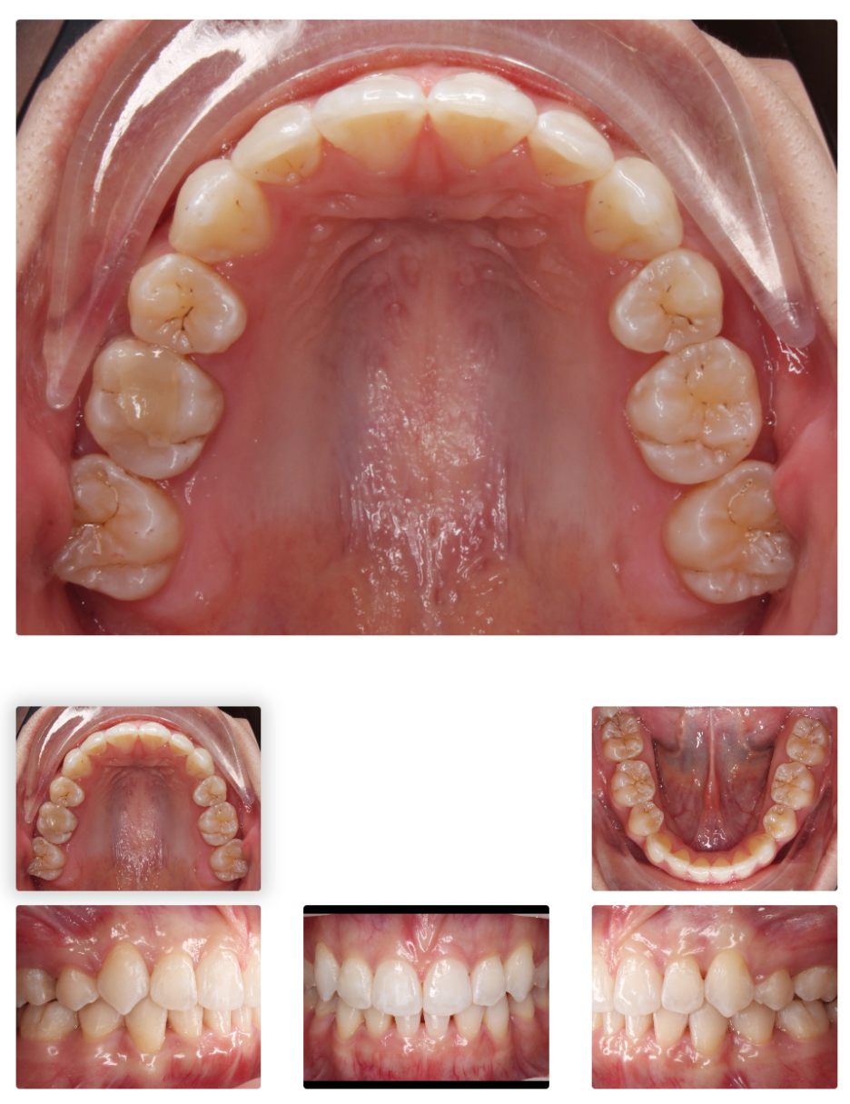Gap Between the Front Teeth? Don’t Judge It by Front Teeth Partial Orthodontic Reviews Alone image 8