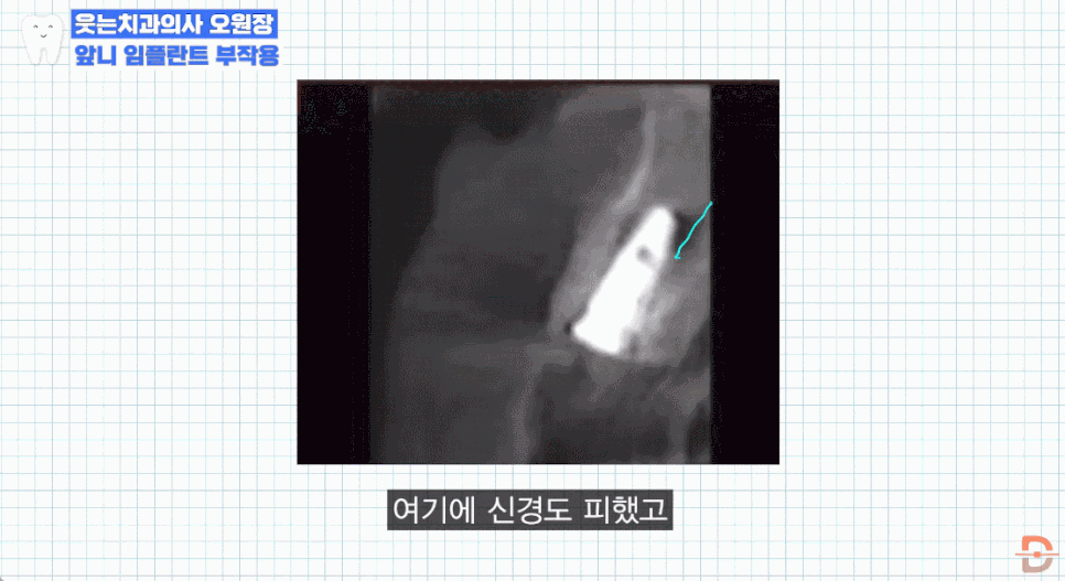 앞니임플란트치과 찾기 전 제발 이 글부터 읽어보세요 관련 이미지 20