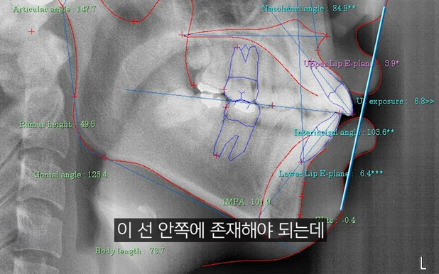 성인 부정교합 교정? 이런 분들은 사실 안 받아도 됩니다 관련 이미지 3