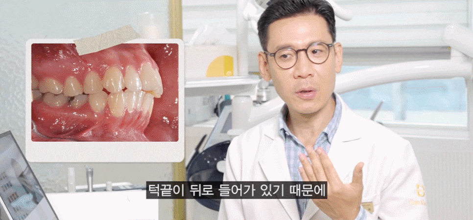 Underbite Tooth Correction? How to Improve a Receded Chin Without Double-Jaw Surgery or Chin Surgery image 5