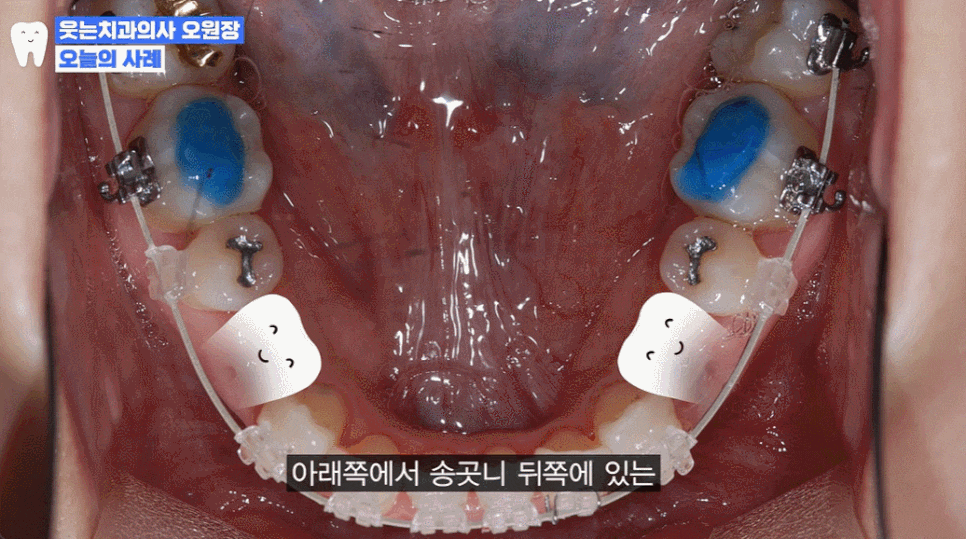 주걱턱 치아교정? 효과적인 주걱턱 교정 시기는 언제 관련 이미지 8