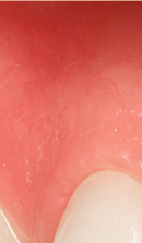 What to Check When Considering No-Prep Laminate Veneers in Gangnam image 30