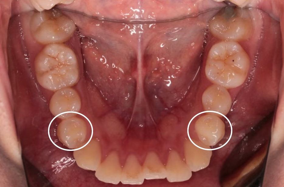 돌출입수술 대신, 인비절라인 돌출입 개선 사례 관련 이미지 12