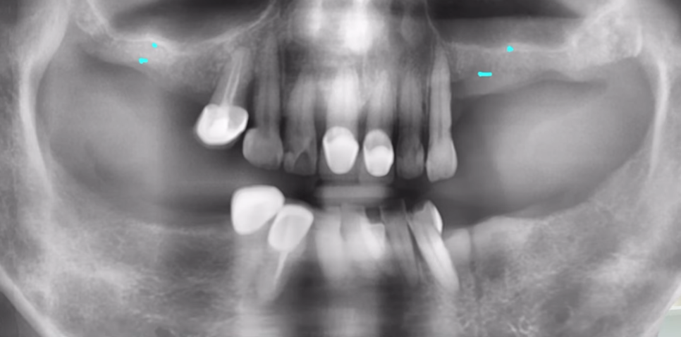임플란트수술? 발치 즉시 vs 발치 후 임플란트 종류 따져보기 관련 이미지 8