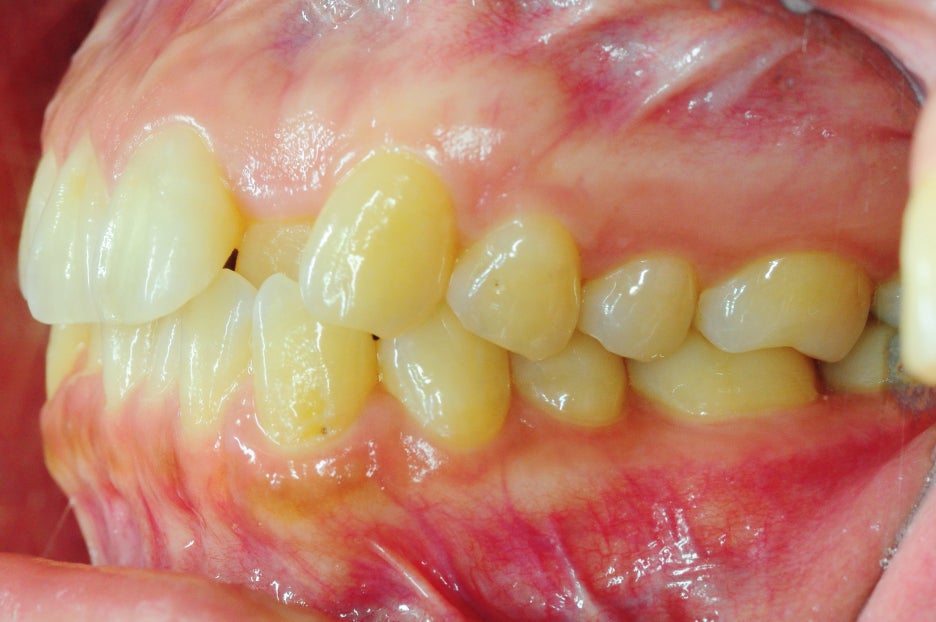 Why Are Invisalign Screws Placed, and How Much Do They Hurt? image 3
