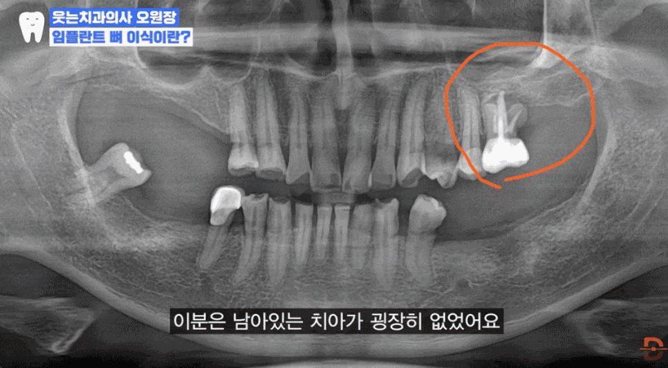 임플란트 뼈이식 비용 들이기 전 이 글부터 읽어보세요 관련 이미지 17