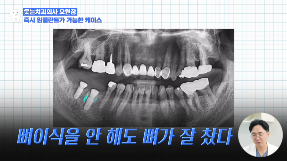 임플란트수술, 당일임플란트로 빠르게 끝내고 싶으신가요? 관련 이미지 8